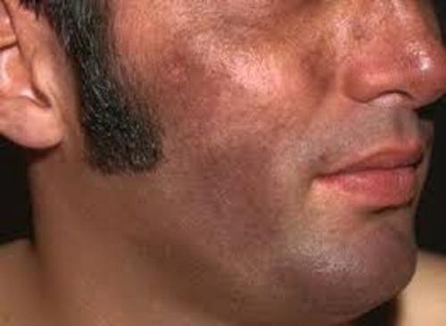 Пигментные пятна почему появляются и как избавиться. Пигментация на лице 08 Пигментные пятна почему появляются и как избавиться. Пигментация на лице 08