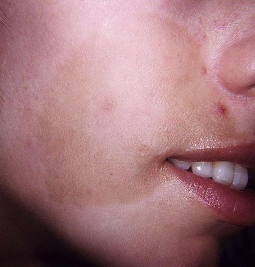 Пигментные пятна почему появляются и как избавиться. Пигментация на лице 07 Пигментные пятна почему появляются и как избавиться. Пигментация на лице 07