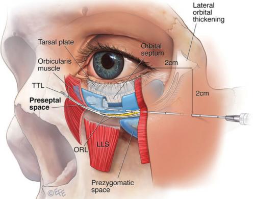 Как убрать круги под глазами. Как убрать круги филлерами.