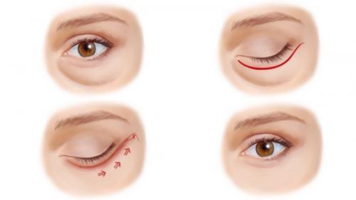 Как убрать темные круги под глазами быстро. Темные «круги» и «мешки» под глазами: в чем причина? 04