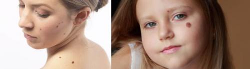 Как убрать пигментные пятна на коже. Пигментное пятно —, что это такое 03 Как убрать пигментные пятна на коже. Пигментное пятно —, что это такое 03