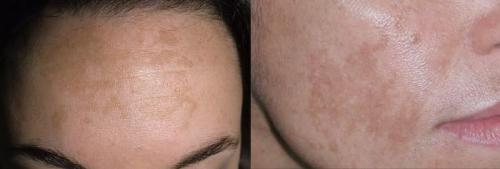 Как убрать пигментные пятна на коже. Пигментное пятно —, что это такое 01 Как убрать пигментные пятна на коже. Пигментное пятно —, что это такое 01