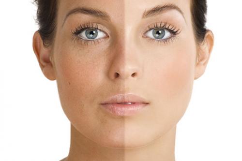 Как убрать пигментные пятна после беременности. Как быстро восстановить нормальный цвет лица? 01