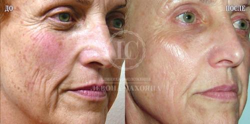 Возвращаются ли пигментные пятна после лазера. Принцип действия лазерной шлифовки пигментных пятен