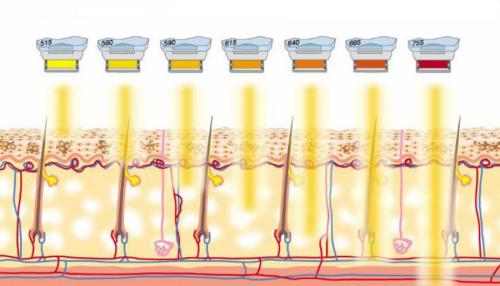 Удаление пигментных пятен лазером. Типы используемых лазеров для удаления пигментных пятен 02