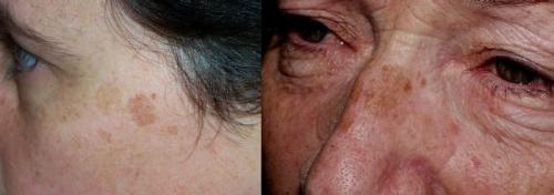 Пигментные пятна симптом проблем со здоровьем. Механизм пигментообразования 01