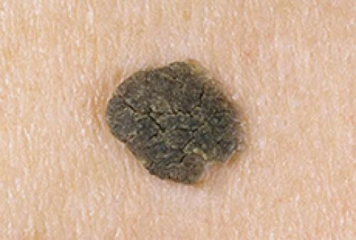 Как пожилым людям избавиться от пигментных пятен на руках. Что такое старческие пятна, и почему они появляются? 01