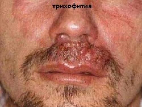 Грибковые заболевания кожи головы – проблема, с которой сталкивался каждый 02