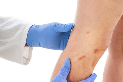 Старческие пятна на коже. Возможные способы устранения возрастной пигментации кожи 02