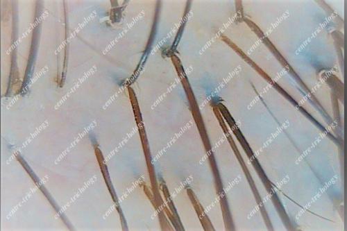 Пилинг кожи головы до и после. Химический и ультразвуковой пилинг волосистой части головы: как проводится процедура