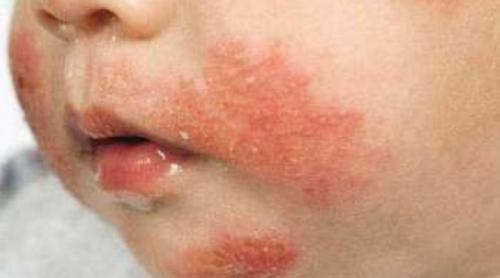 Атопический дерматит у детей лечение комаровский. Атопический дерматит у детей