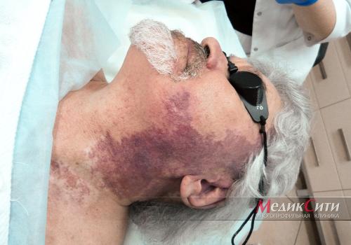 Фототерапия от пигментных пятен на лице и руках. Виды сосудистых нарушений, которые мы лечим с помощью фототерапии: 01 Фототерапия от пигментных пятен на лице и руках. Виды сосудистых нарушений, которые мы лечим с помощью фототерапии: 01