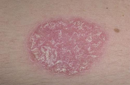 Темное пятно на коже, как синяк. Оксана Жосан, гинеколог-онколог. Редактор А. Герасимова