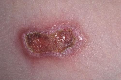 Темное пятно на коже, как синяк. Оксана Жосан, гинеколог-онколог. Редактор А. Герасимова