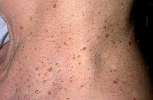 Что такое себорейный кератоз. Себорейный кератоз кожи: лечение