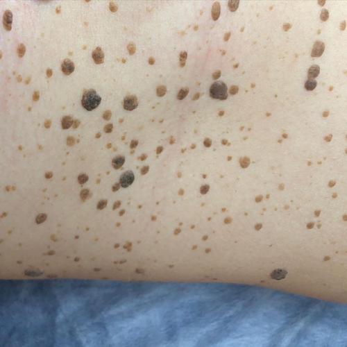 Что такое себорейный кератоз. Себорейный кератоз кожи: лечение 07