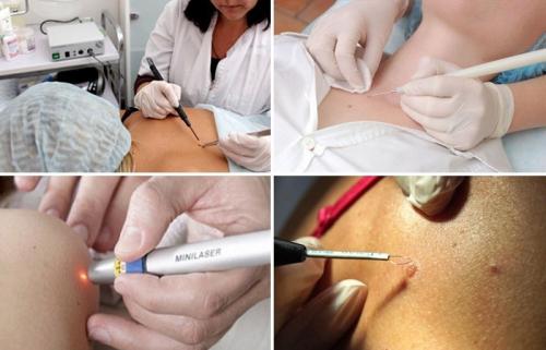 Что такое себорейный кератоз. Себорейный кератоз кожи: лечение