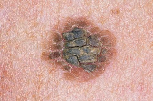 Что такое себорейный кератоз. Себорейный кератоз кожи: лечение