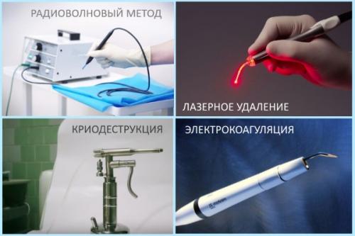 Себорейный кератоз нужно ли удалять. Удаление проявлений кератоза