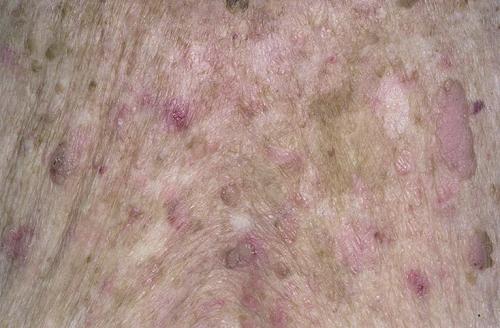 Что такое себорейный кератоз. Себорейный кератоз кожи: лечение