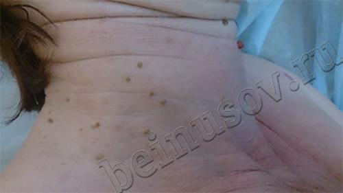Все причины появления папиллом на теле. Симптоматика 01
