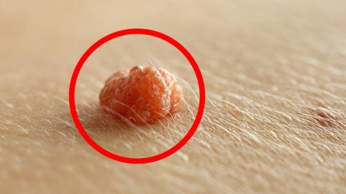 Папилломы на теле причины. Папилломы на теле: причины