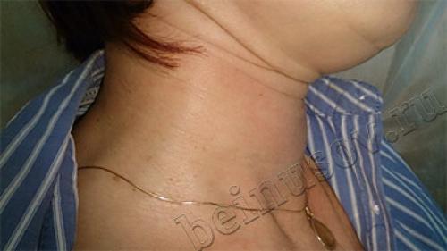 Все причины появления папиллом на теле. Симптоматика 02