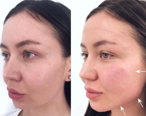 Это уже не модно. Устаревшие бьюти-процедуры: что не модно в 2021 06