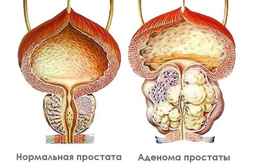 Самое сильное средство от аденомы простаты. Все об аденоме простаты и новационных методах ее лечения