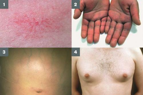 Функции печени в нормализации избыточного веса. Диетотерапия и модификация образа жизни 01