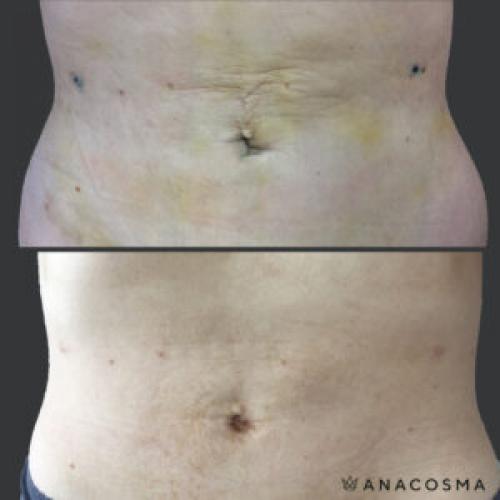 Дряблая кожа на животе после родов форум. Как убрать живот после родов?