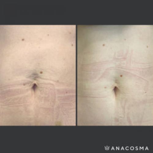 Дряблая кожа на животе после родов форум. Как убрать живот после родов?