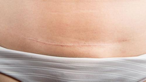 Сколько заживают швы после операции. Лечение рубцов после пластических операций (Радецкая Лариса Иосифовна) (обновлен. 2023) 02