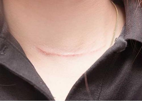 Сколько заживают швы после операции. Лечение рубцов после пластических операций (Радецкая Лариса Иосифовна) (обновлен. 2023) 05