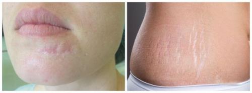 Сколько заживают швы после операции. Лечение рубцов после пластических операций (Радецкая Лариса Иосифовна) (обновлен. 2023) 01