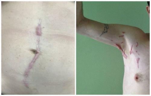 Сколько заживают швы после операции. Лечение рубцов после пластических операций (Радецкая Лариса Иосифовна) (обновлен. 2023) 03