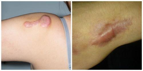 Сколько заживают швы после операции. Лечение рубцов после пластических операций (Радецкая Лариса Иосифовна) (обновлен. 2023) 04